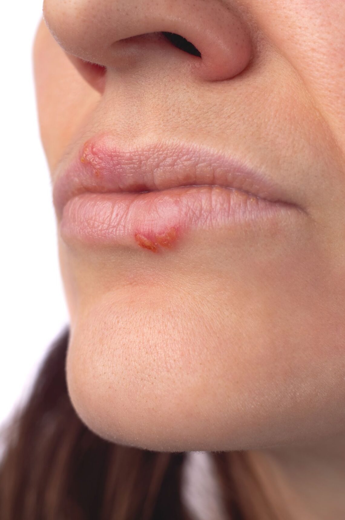 Why I'll (probably) never suggest you do a Herpes blood test. Ames